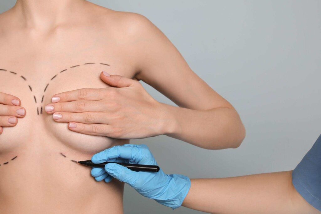doctor drawing marks on female breast for cosmetic surgery operation