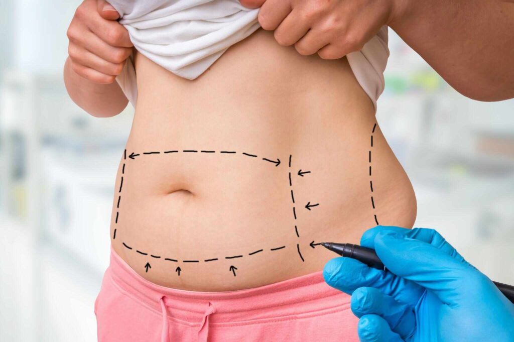 plastic surgery doctor draw lines with marker on patient belly