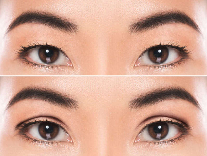 before and after Asian blepharoplasty or double eyelid surgery