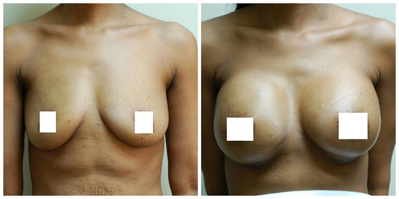 Breast augmentation before and after