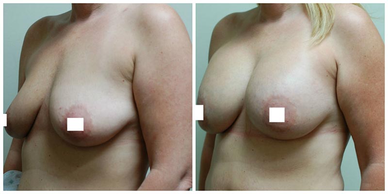 Breast augmentation before and after