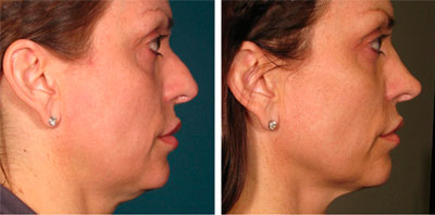 before and after rhinoplasty procedure