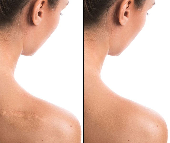 woman's shoulder before and after keloid removal